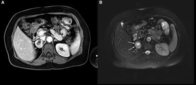 An unusual finding after adrenal surgery: a case series of adrenal schwannomas